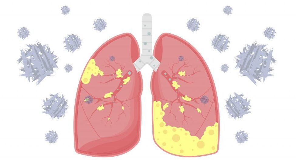 Asbestos Lung Cancer